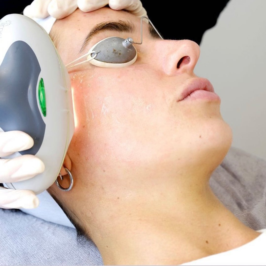 limelight ipl laser therapy scranton pa